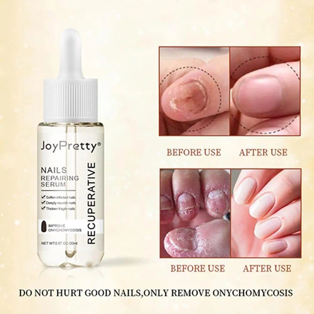 7 DAYS Repair Nail Fungus Treatments Essence Foot Care Fungal Nails Toe Removal Anti-Infection Onychomycosis Serum Gel Q0P8