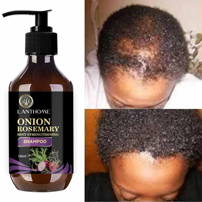 Hair Shampoo For Fast Hair Growth Rosemary Onion Hair Regrowth Shampoo Anti Hair Loss Effective Within 7 Day Hair Care Spray